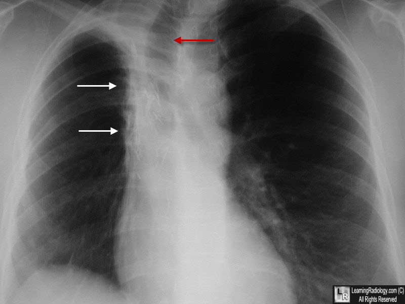 Radiation fibrosis